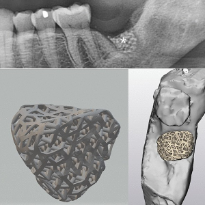 IA-Bone Grafts & Scaffolds-S