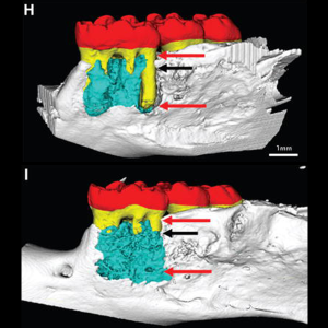 IA-Periodontal Defect Volume